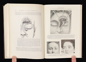 Rhinology Illustrated Medical Textbook 1910 Nasal Surgery Rhinolaryngology